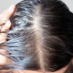 does dry shampoo cause hair loss